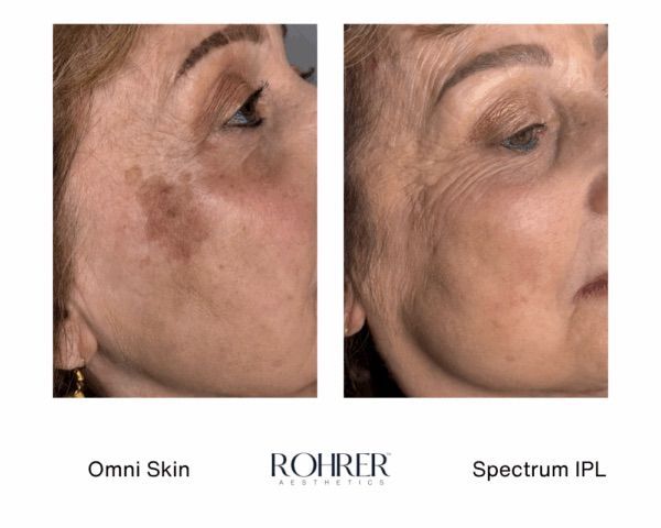 Before and after in Evergreen Colorado of IPL photofacial