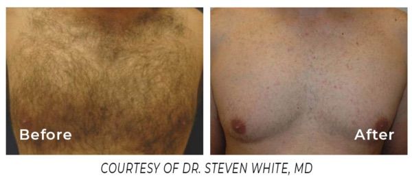Evergreen Colorado laser hair removal at Lela Skin Care and Facials