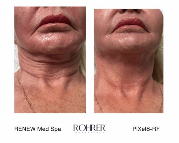 Before and after in Evergreen Colorado of radiofrequency microneedling