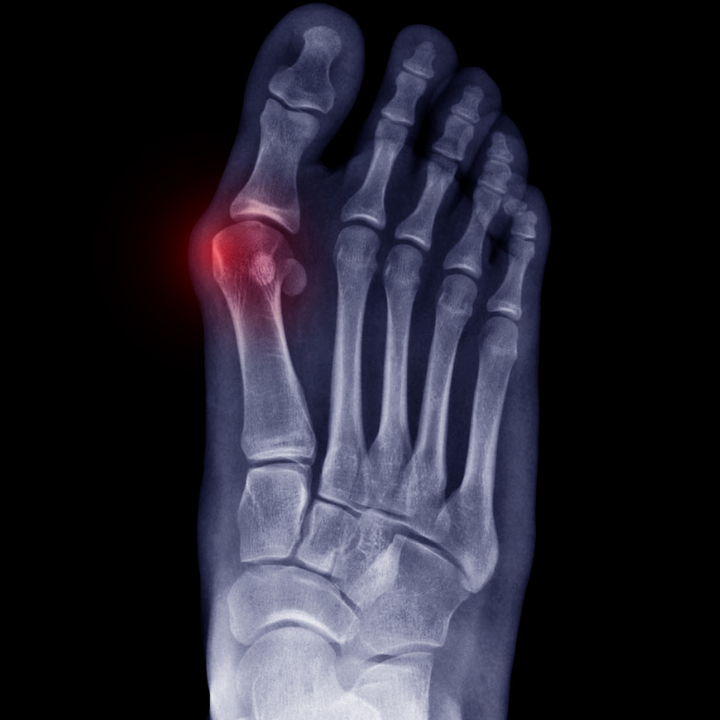 an image showing an issue in a foot, which may need bunion surgery or treatment. Ankle and Co. in Leeds, UK treat bunions.