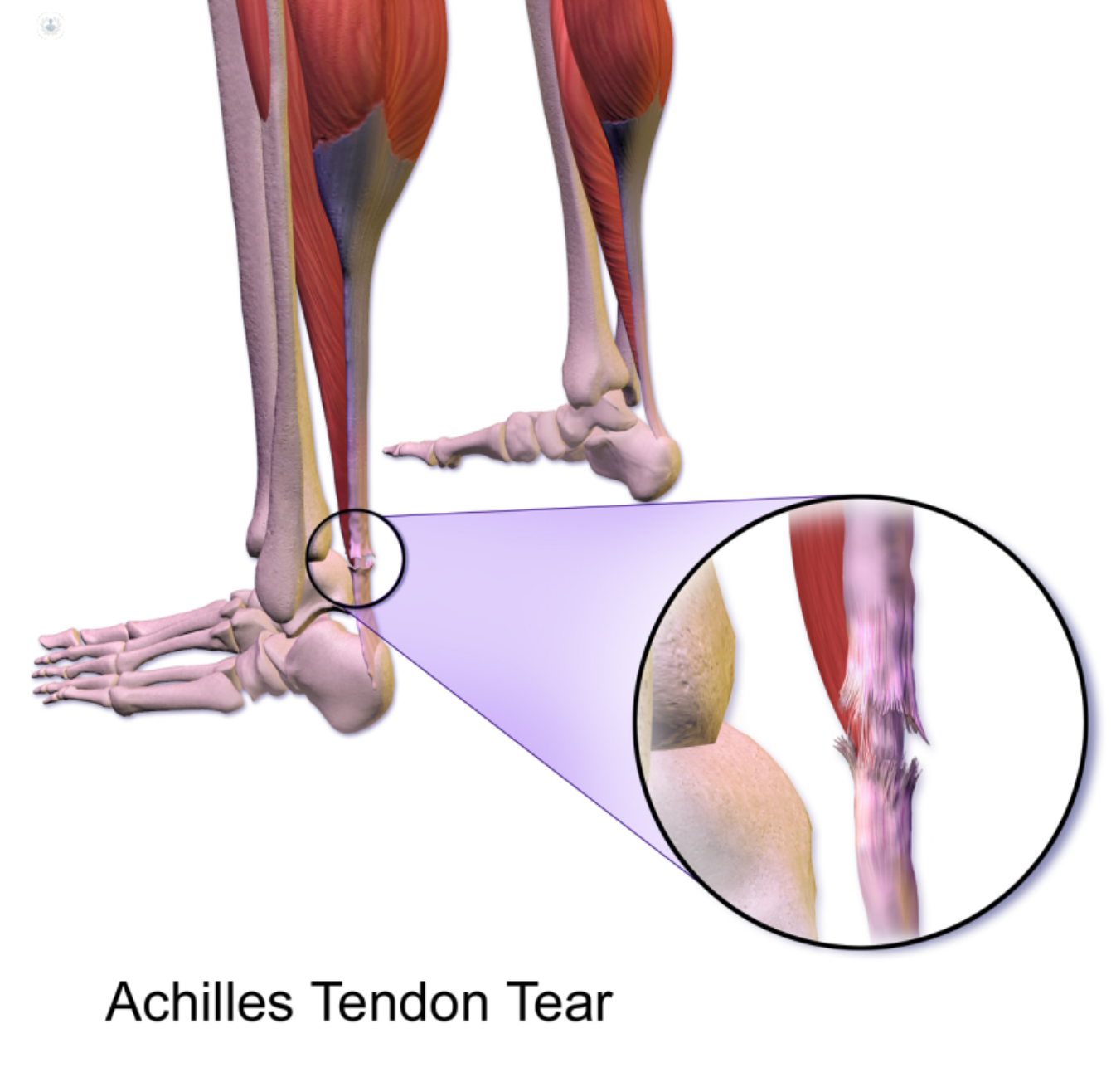 an image showing an achilles tendon tear, which may need to be treated by Achilles Tendon Repair Surgery or reconstruction