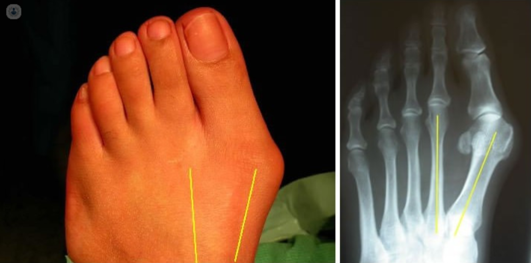 An X-Ray of a foot, showing a bunion. These can be treated at Ankle& Co. Leeds.
