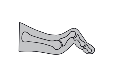Diagram of a Hammer Toe, a type of lesser toe deformity.