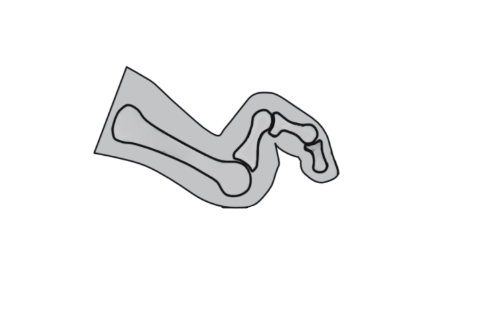 Claw toe diagram, a less toe deformity. These can be treated at Ankle and Co. Leeds