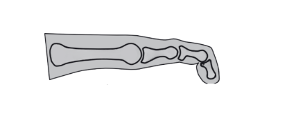 Understanding lesser toe deformities: diagram of a mallet toe, this can be treated at Ankle and Co.