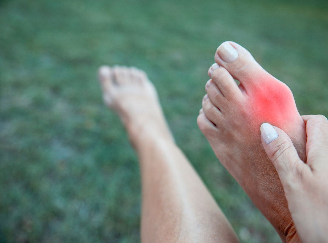 Bunions can be helped by visiting Ankle and Co. near Leeds.
