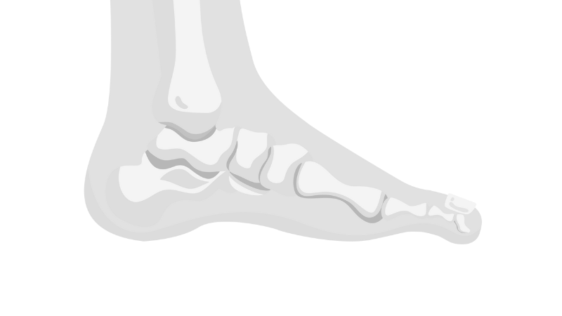 an image showing an issue in a foot, which may need bunion surgery or treatment. Ankle and Co. in Leeds, UK treat bunions.
