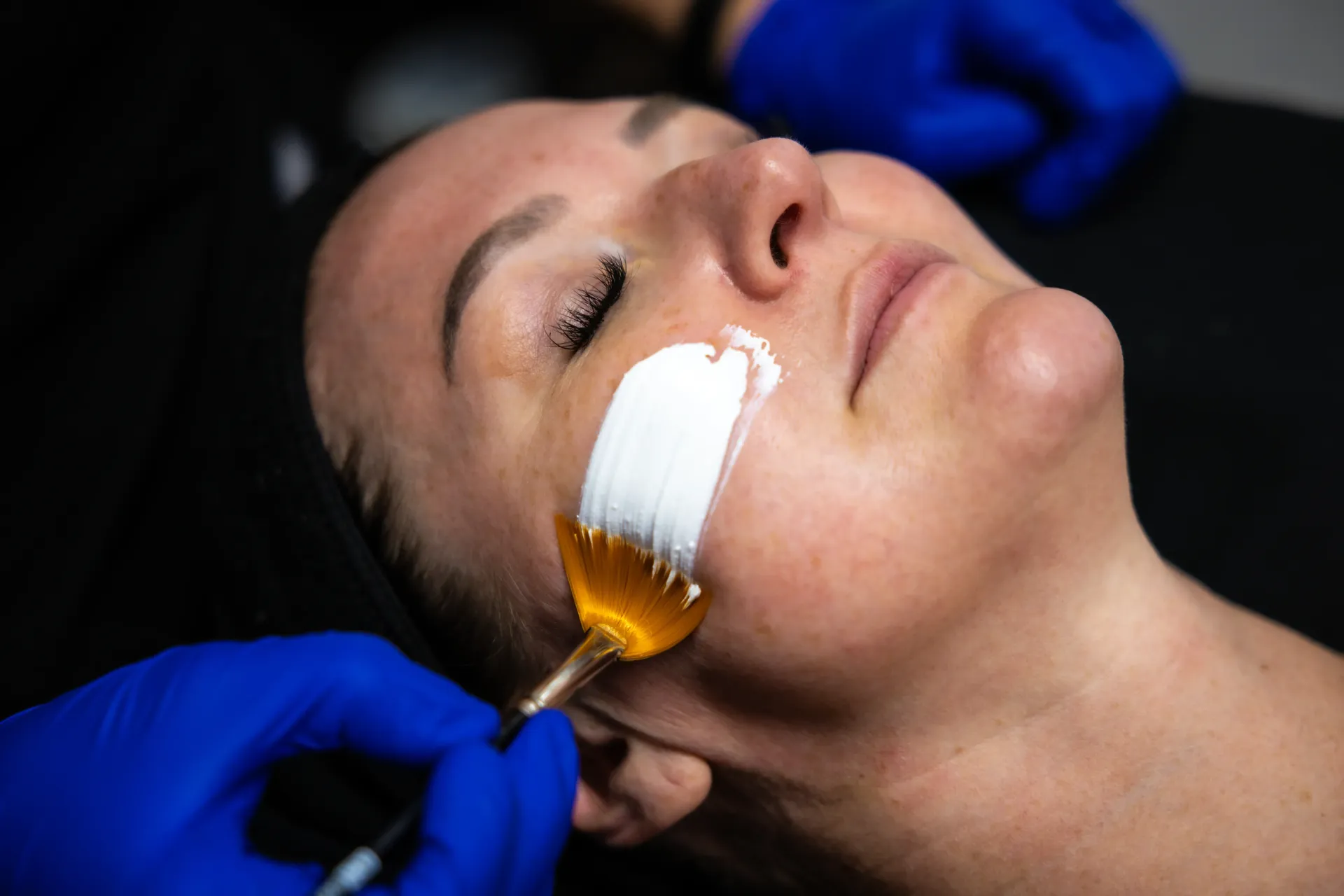 A person receives a facial waxing treatment with white wax applied to the cheek.