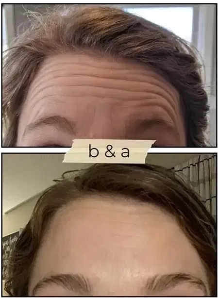 Before-and-after close-up of a forehead showing wrinkles above the eyes, with “b&a” centered between the two images
