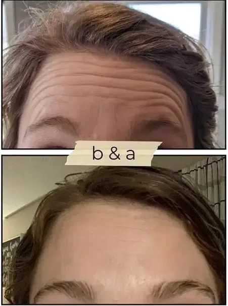 Before-and-after close-up of a forehead showing wrinkles above the eyes, with “b&a” centered between the two images