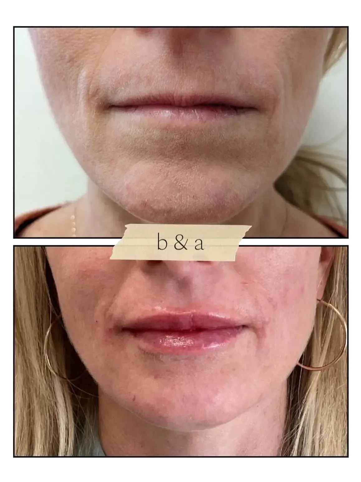 Close-up before-and-after lower-face photo showing smoother lips and skin in the bottom image.