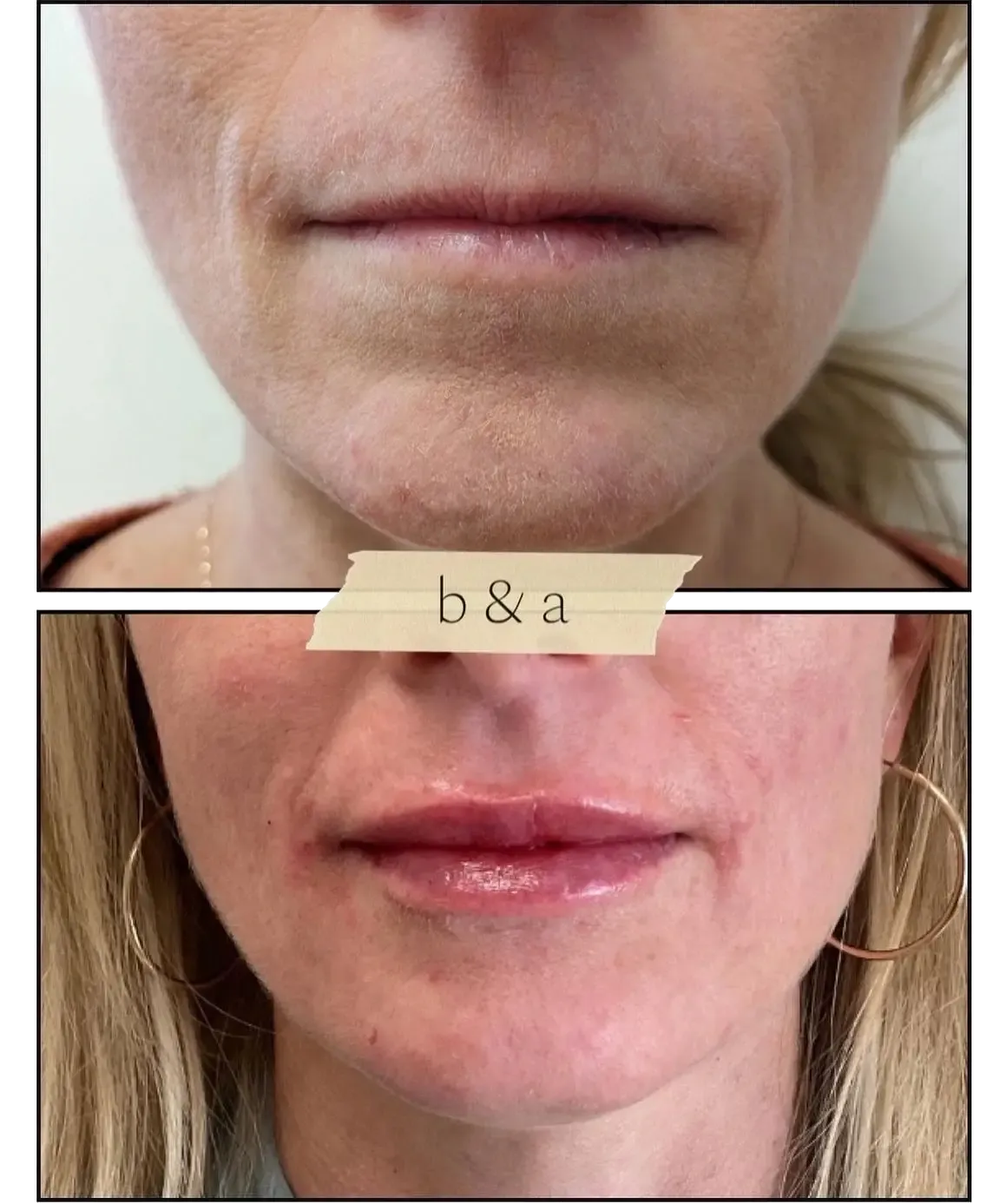 Before-and-after close-up of lips and lower face, showing reduced fine lines and fuller lips.