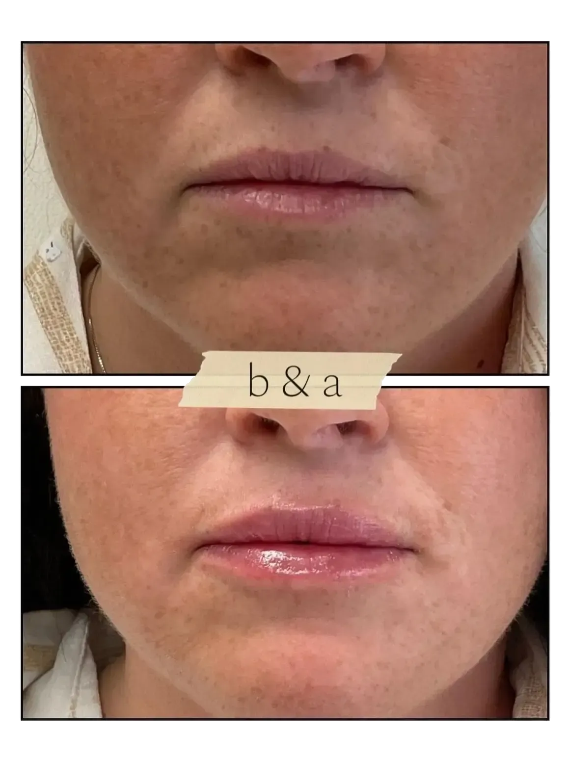 Close-up before-and-after of lips and chin, with a horizontal divider and slight change in facial appearance.