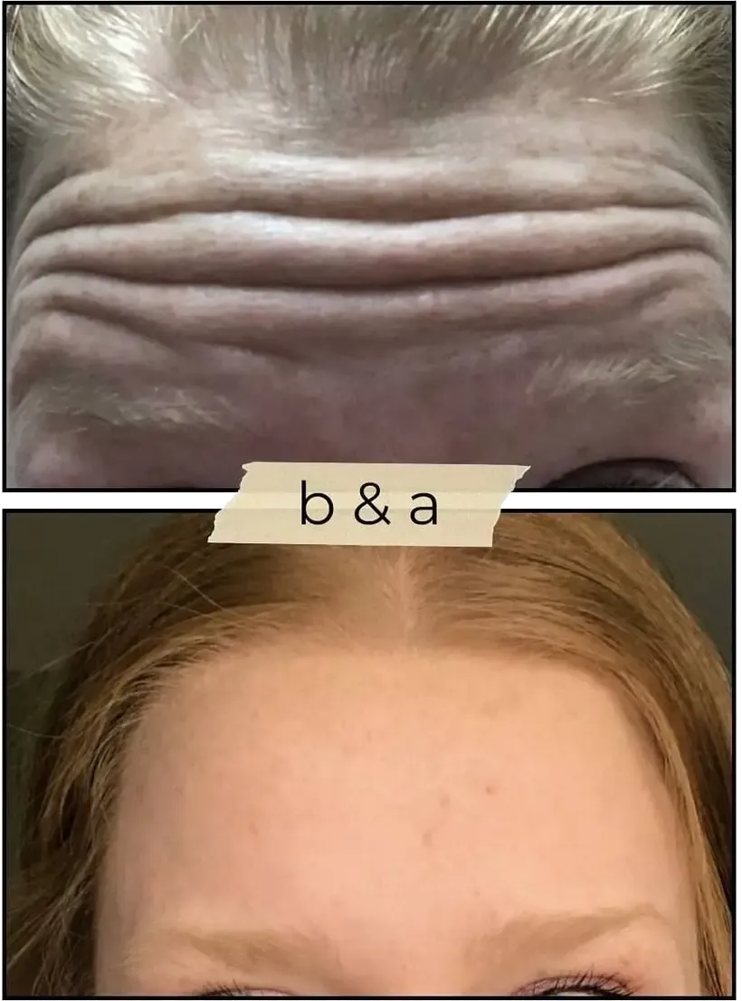 Before-and-after forehead close-up showing deep wrinkles above smooth skin.