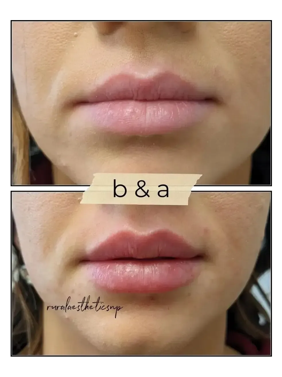 Before-and-after close-up of lips, with a centered “b&a” label between the two photos.