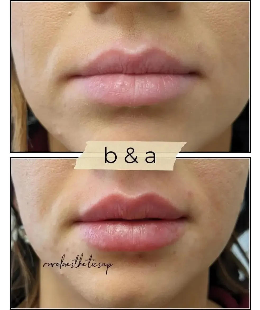 Side-by-side close-up of lips labeled “b&a,” showing before and after lip enhancement.