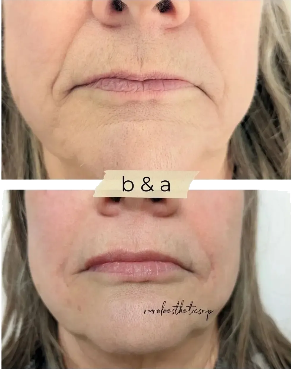 Before-and-after close-up of lower face, showing improved skin texture and lip lines.