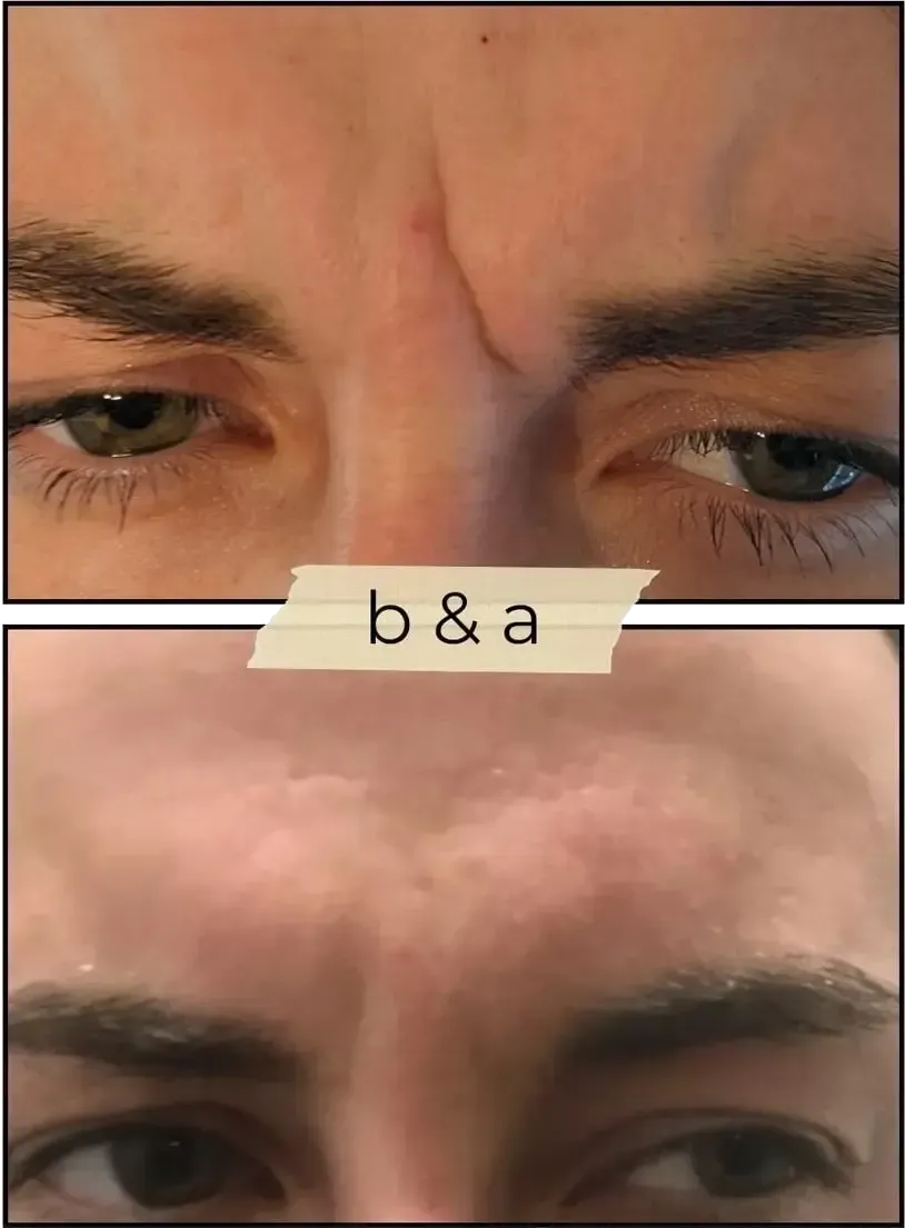 Close-up of two furrowed brows with eyes looking downward, separated by a small “b&a” label.
