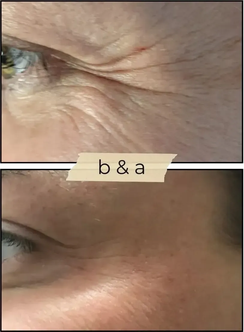 Side-by-side close-ups of an eye and temple before and after treatment, separated by a “b&a” label