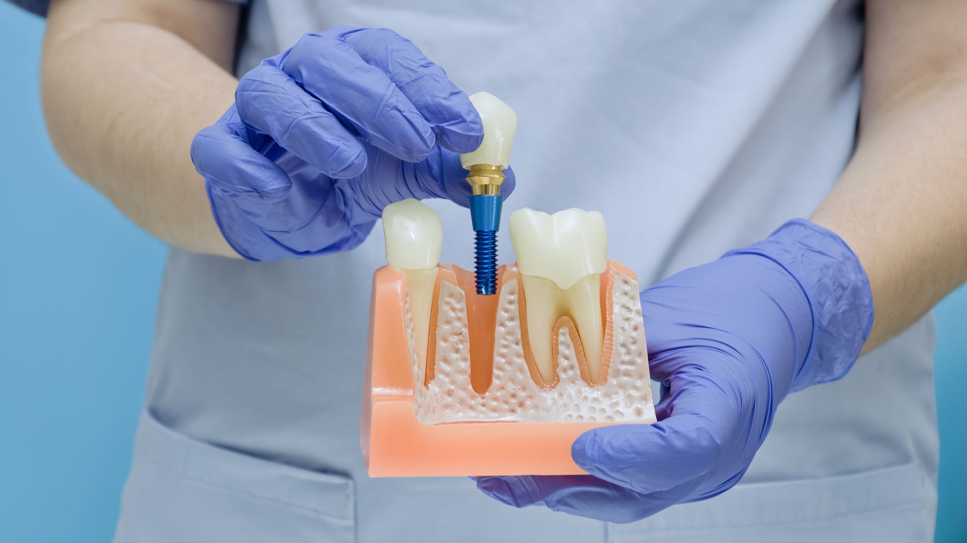 Gloved hands holding a dental implant model with teeth and blue screws
