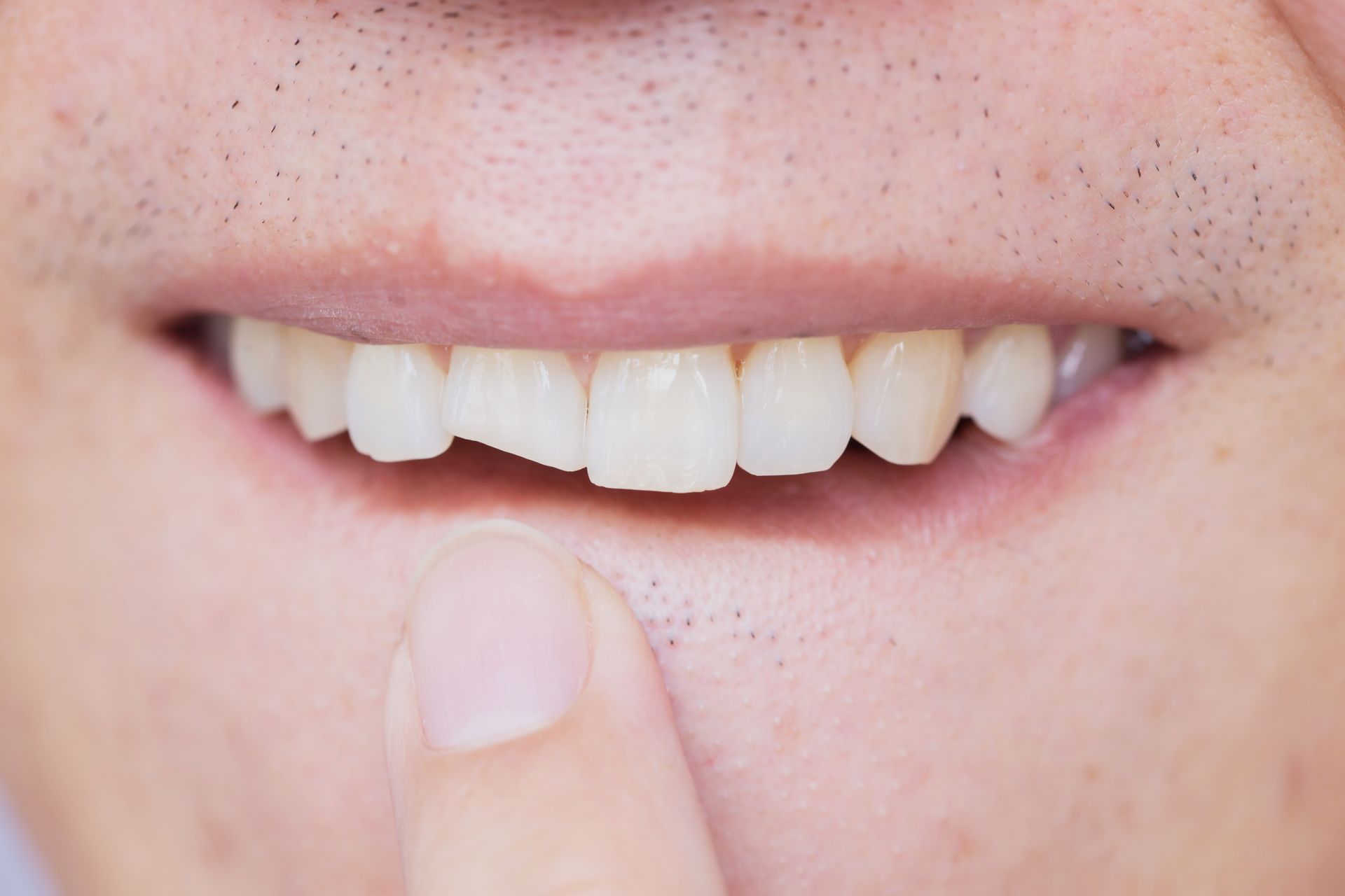 Close-up of a smiling mouth with a finger pointing to a front tooth gap