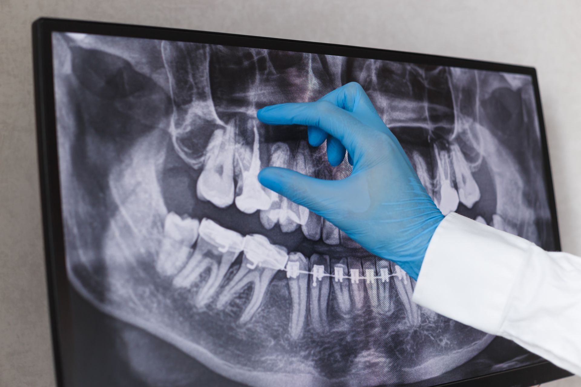 Gloved hand pointing at a dental X-ray on a wall display