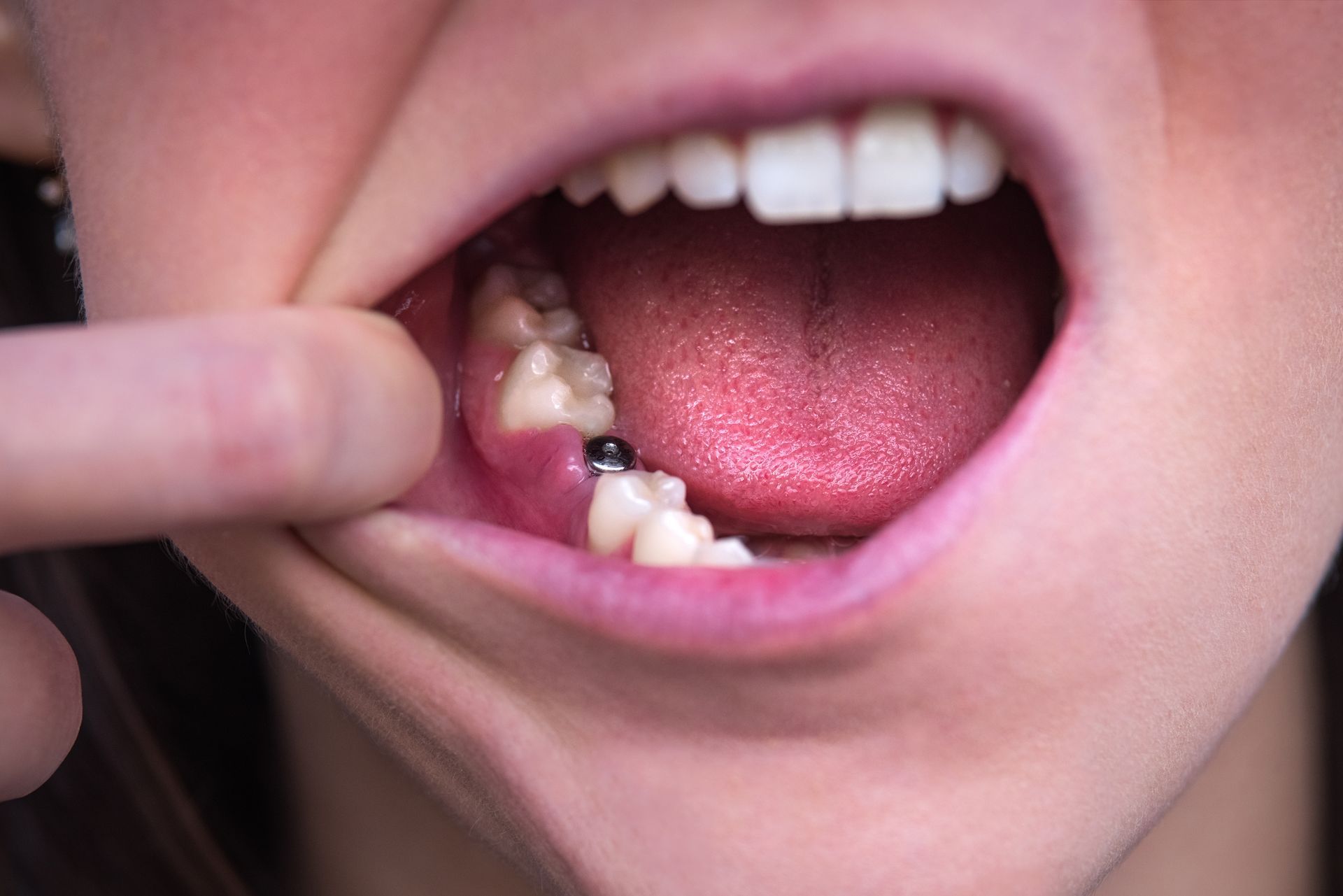 Mouth open wide showing a decayed back tooth while a finger pulls the lip aside