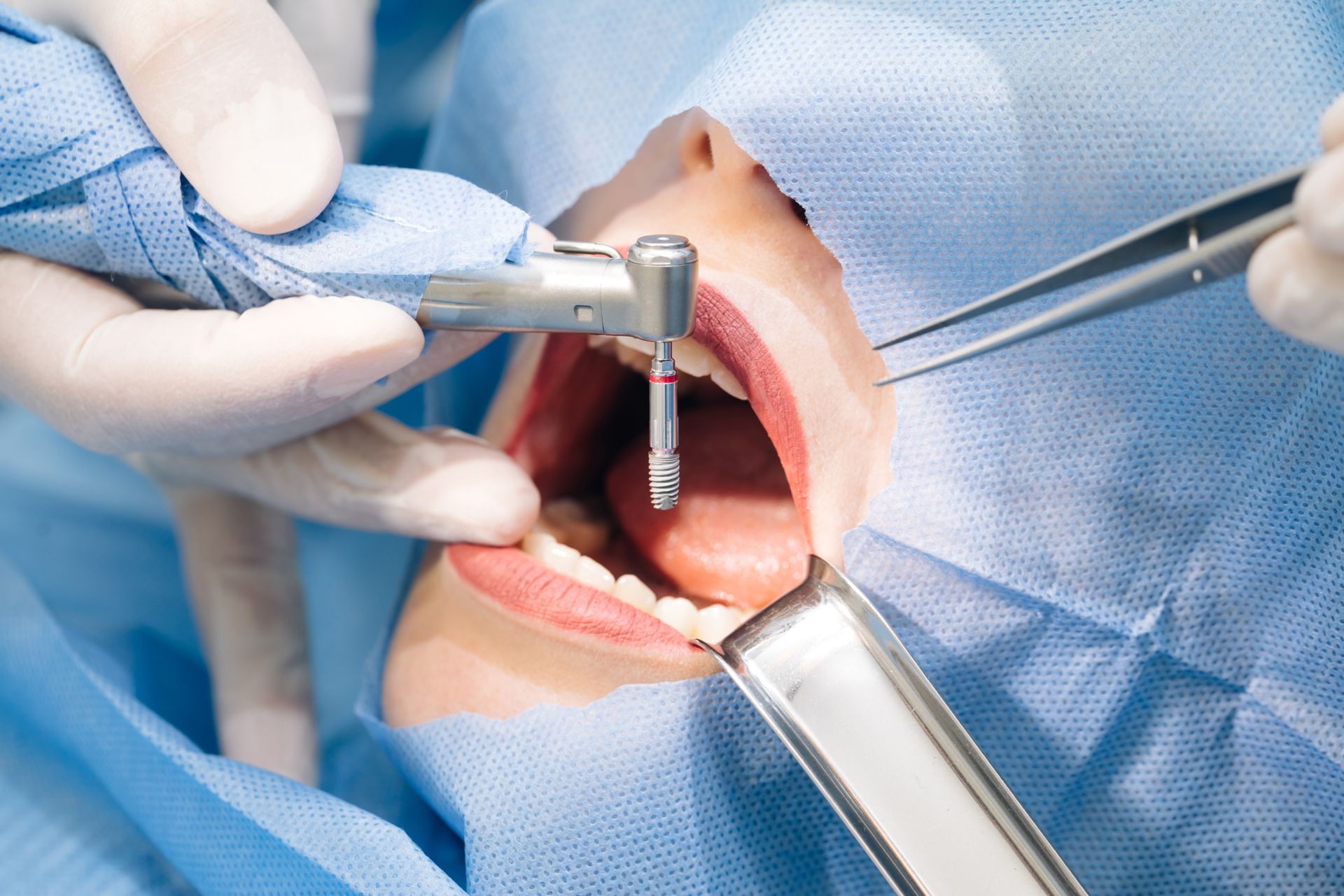 Dentist using a drill on a patient's open mouth during a dental procedure