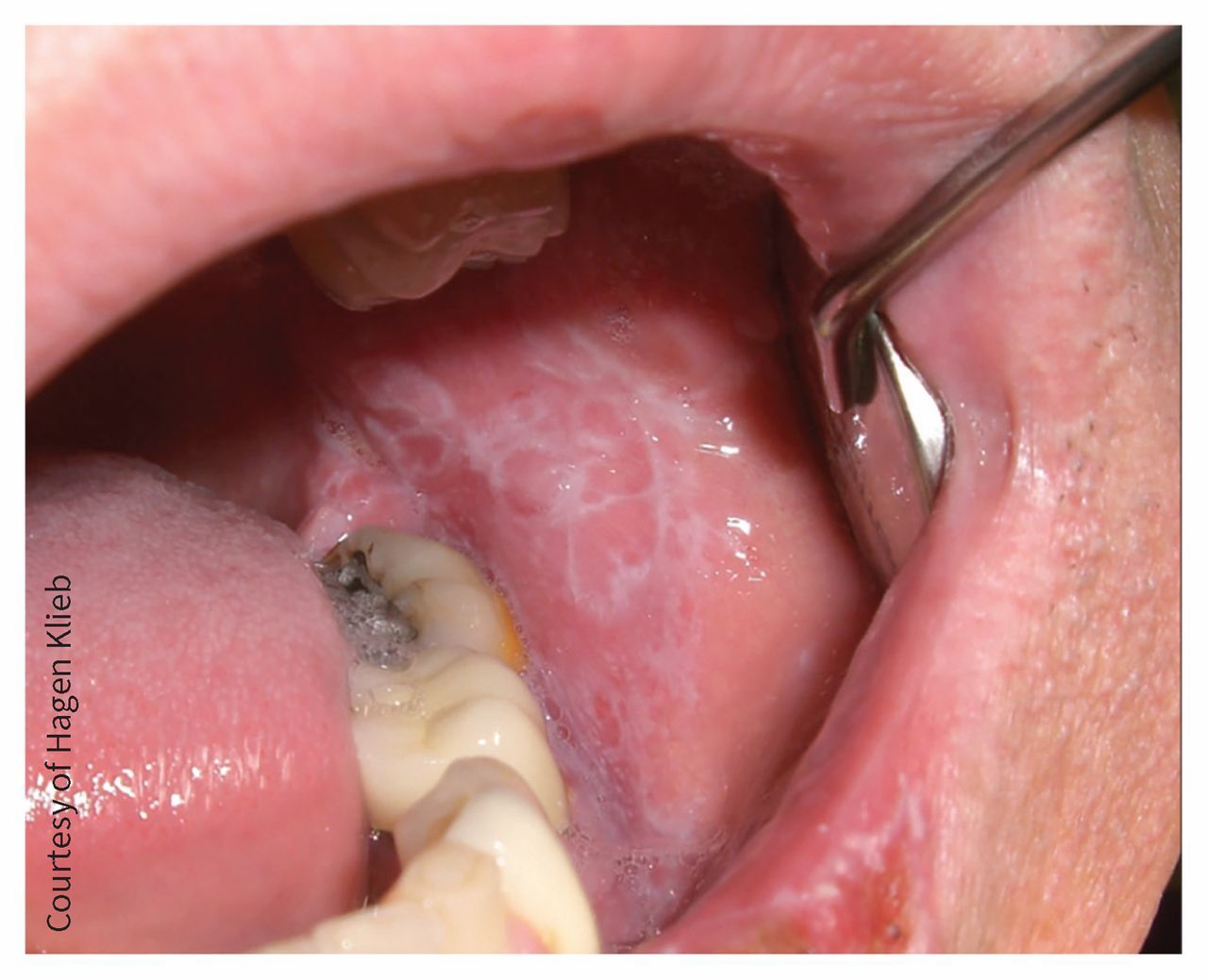 Lichen Planus