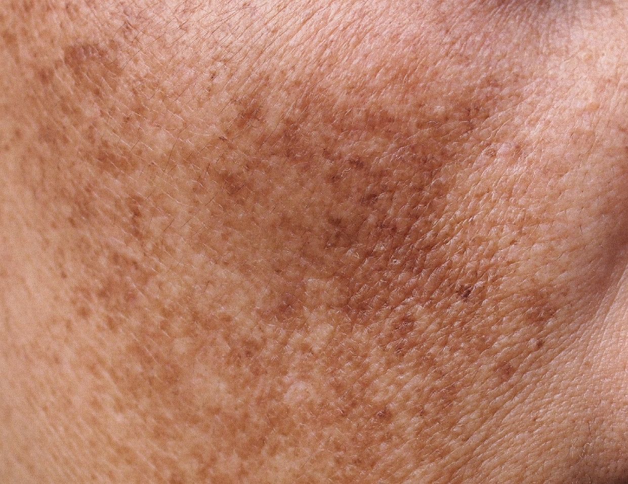 Melasma