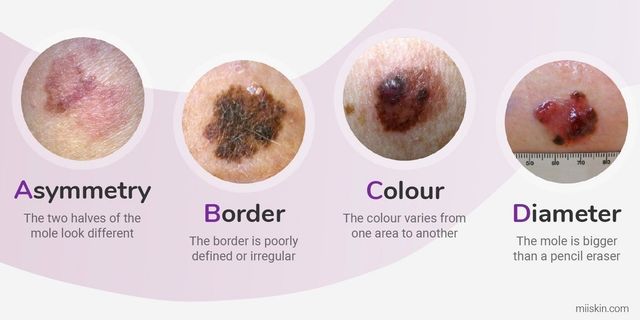 melanotic vs melenic Visual assessment of melanoma Smoking tends to decrease Flavor:Chocolate crescina hairloss