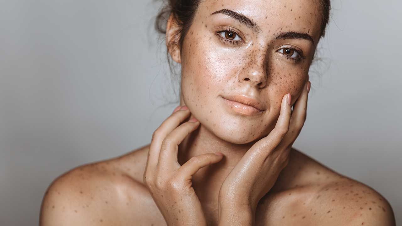 Melasma