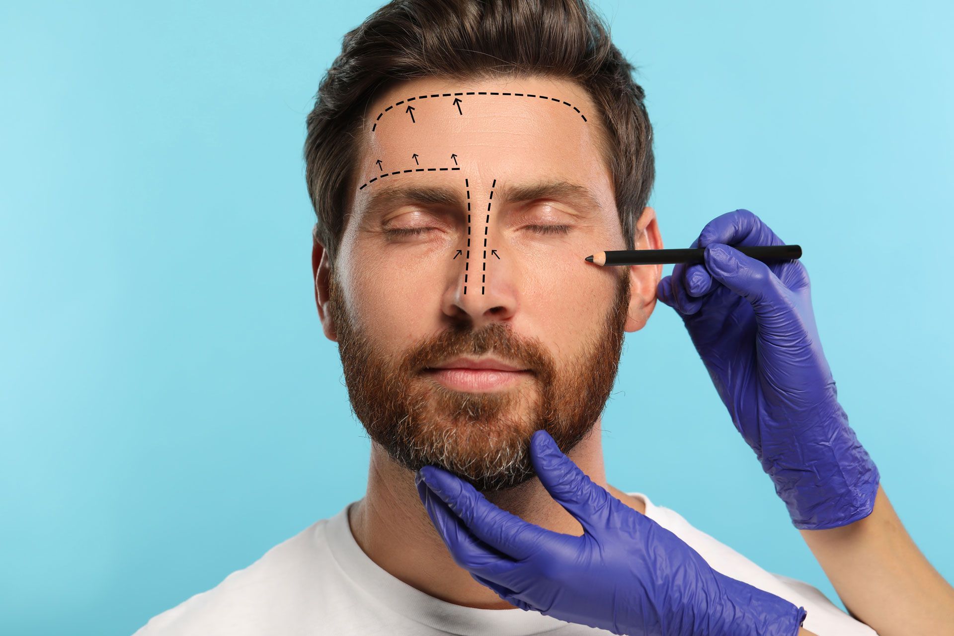 A person with markings on their face for cosmetic surgery, while a gloved practitioner holds a marker against their cheek.