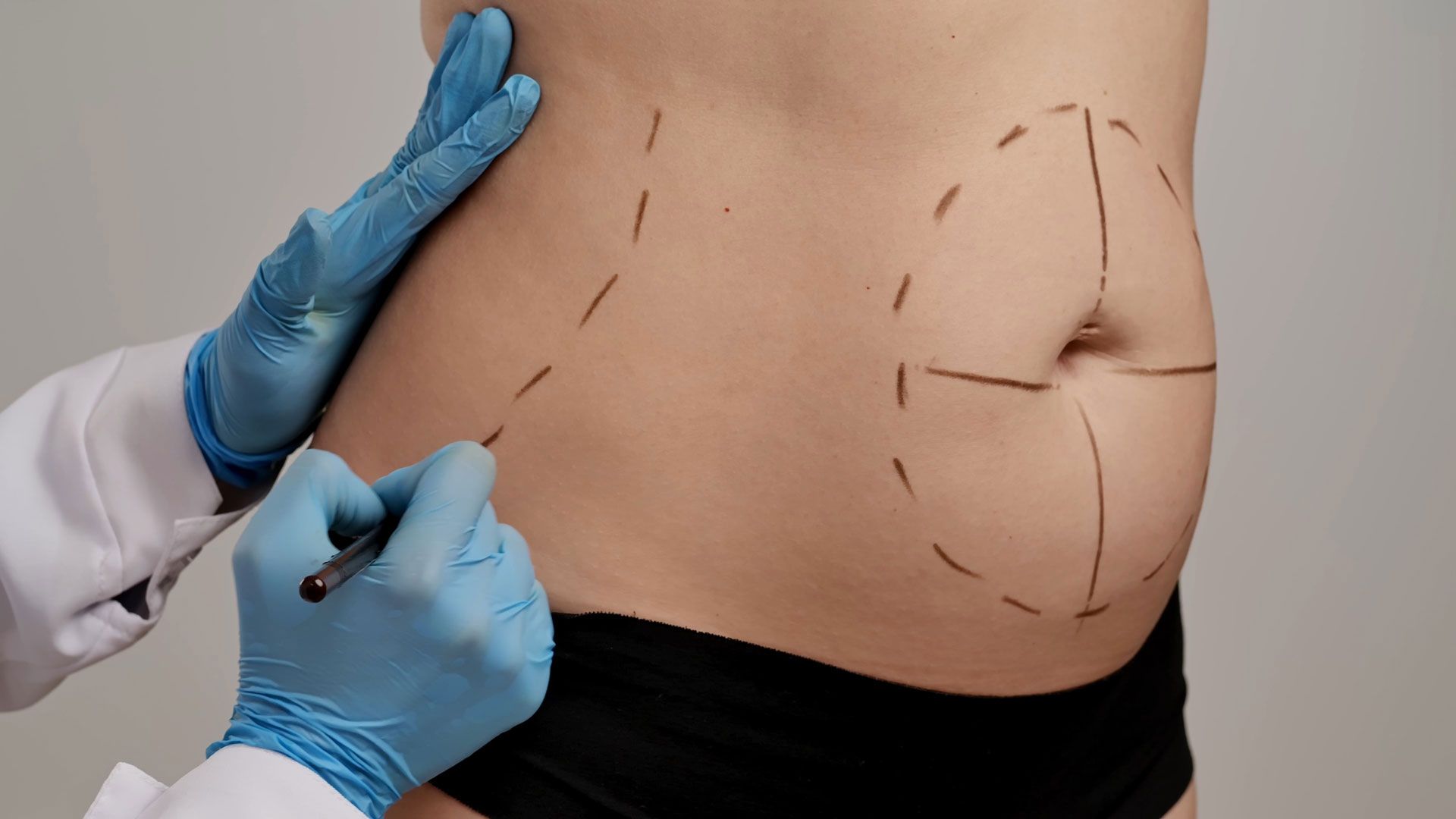 Gloved hands marking an abdomen for cosmetic surgery with surgical pen