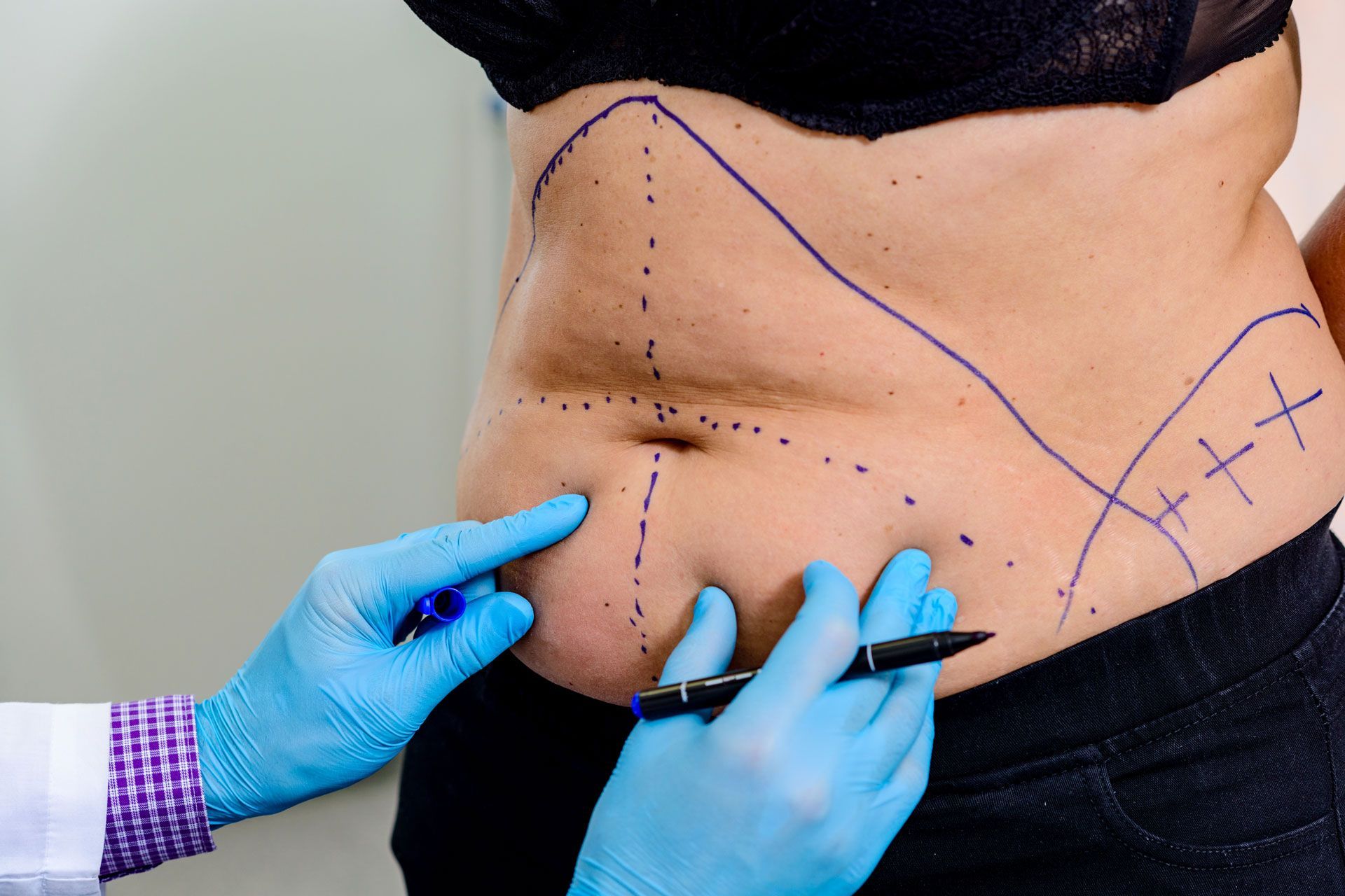 A medical professional in blue gloves marks a patient's abdomen with a pen, indicating areas for a surgical procedure.