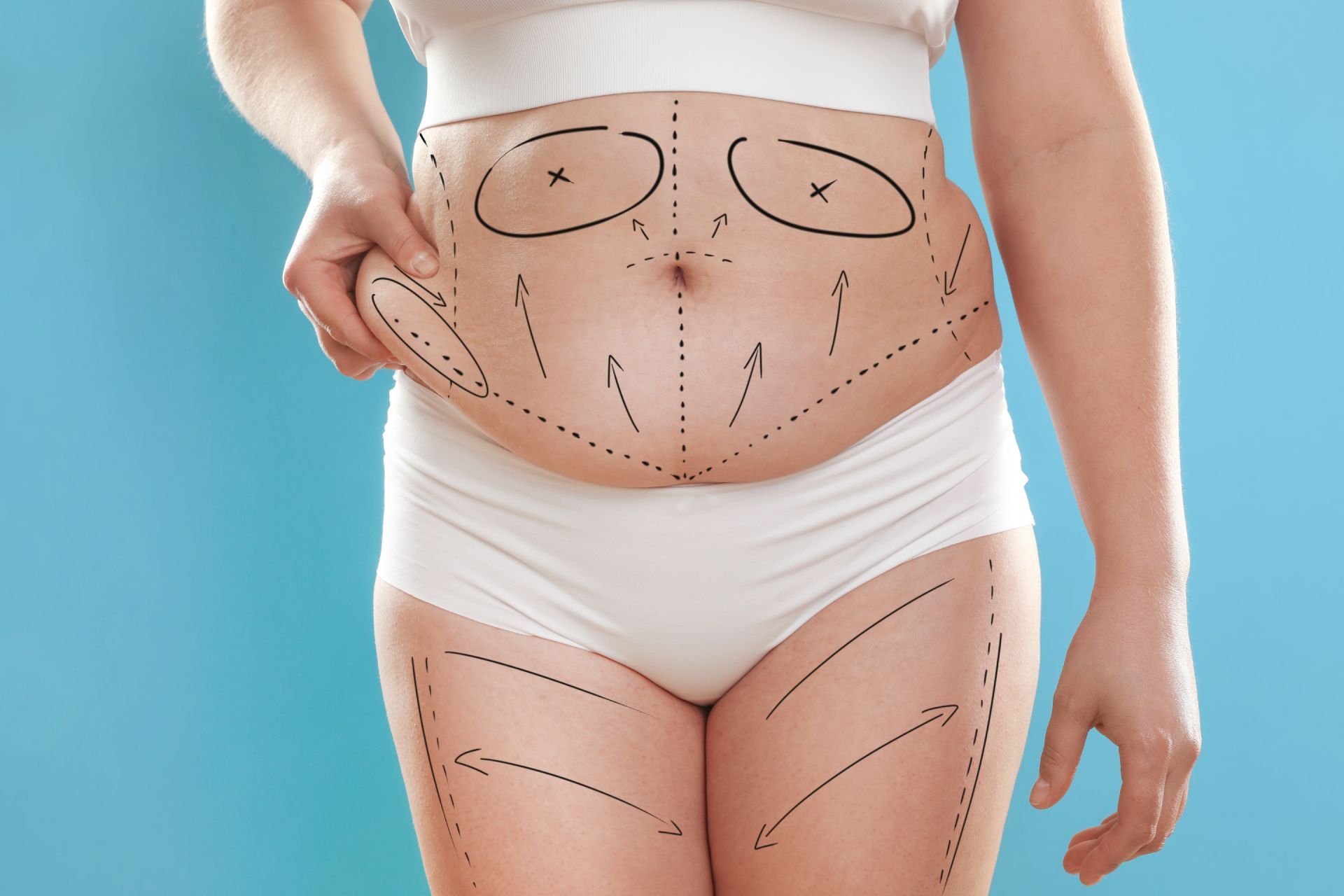 Woman’s hip and thigh with dotted contour overlay, suggesting body contouring or slimming treatment