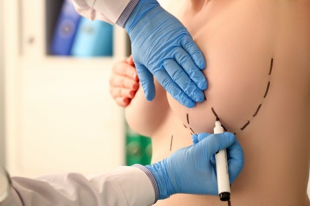 A person in a neutral-colored compression garment for the chest, holding their chest with both hands.