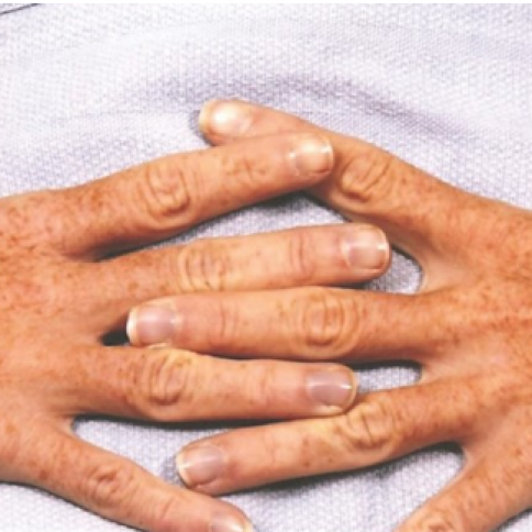 Before Hand Rejuvenation Before Hand Rejuvenation