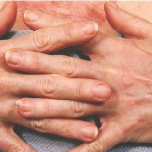 After Hand Rejuvenation After Hand Rejuvenation