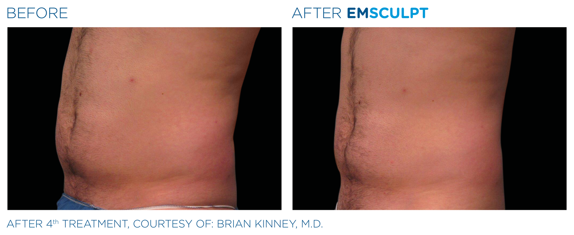 Before and After EmSclupt Therapy Before and After EmSclupt Therapy