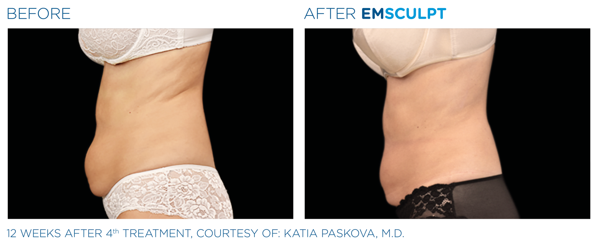 Before and After EmSclupt Procedure Before and After EmSclupt Procedure