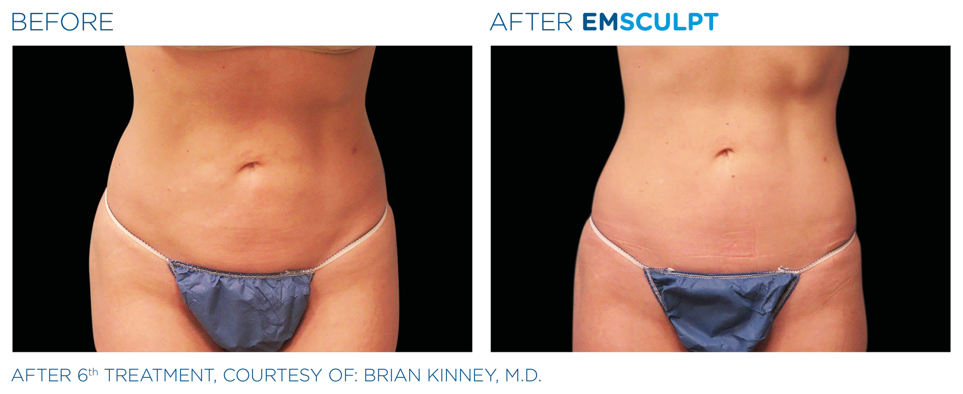 Before and After EmSclupt Before and After EmSclupt