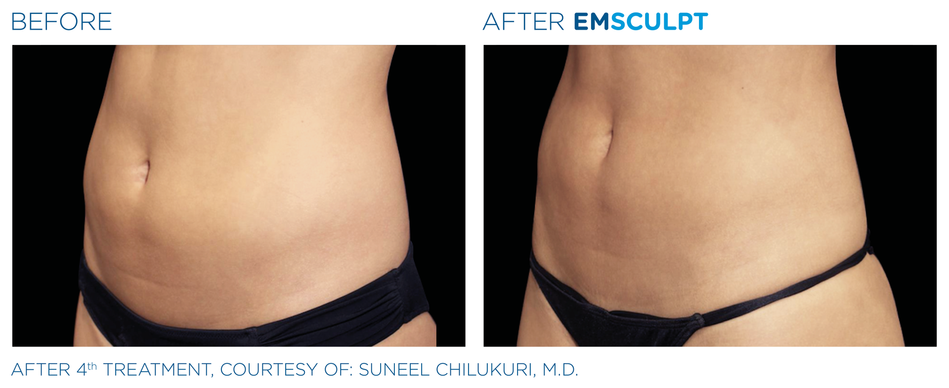 Before and After EmSclupt Session Before and After EmSclupt Session