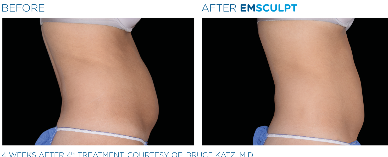Before and After EmSclupt Procedure of the Woman Before and After EmSclupt Procedure of the Woman