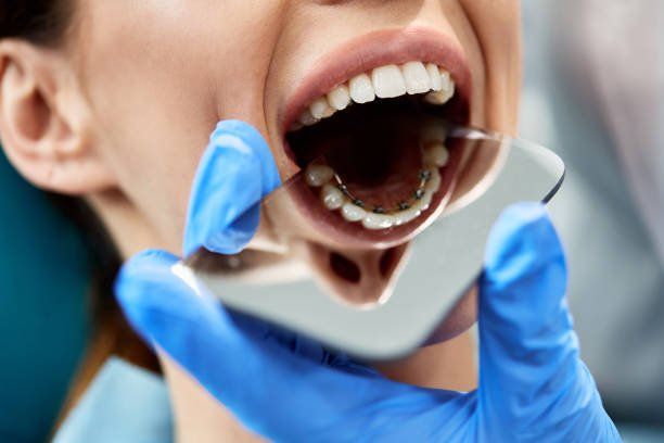 Lingual braces