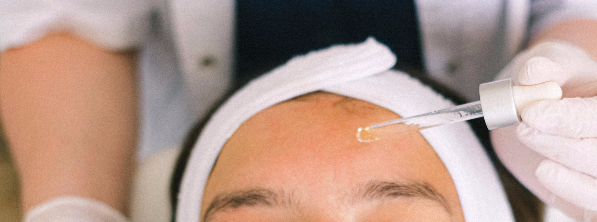 rosacea