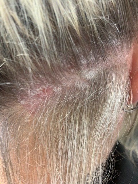Derma rash photo by Vamp Hair Boutique in Blenheim NZ