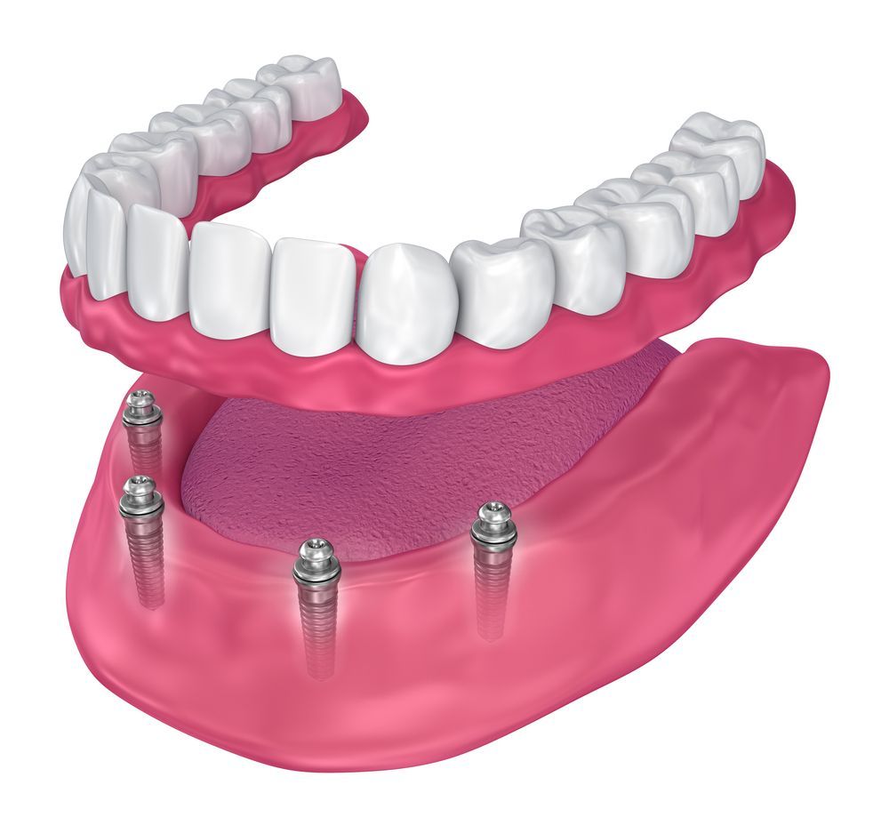 Dental illustration of dentures, top and bottom, attached to dental implants.