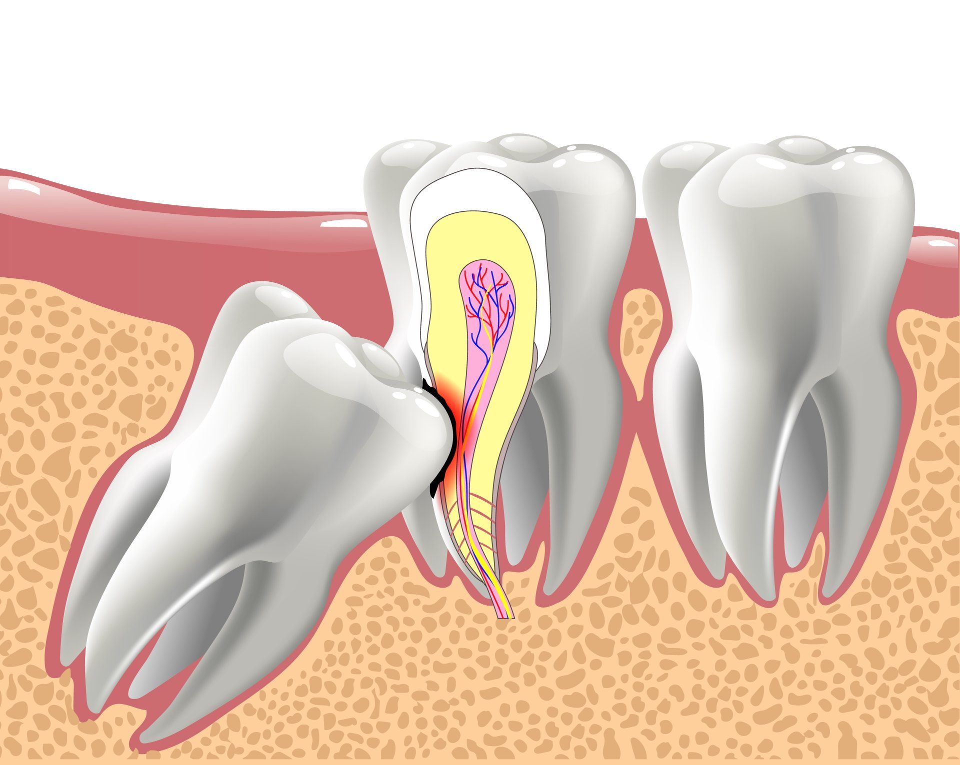 Illustration of impacted wisdom tooth, with cross-section showing root and pulp, next to other molars in gum.