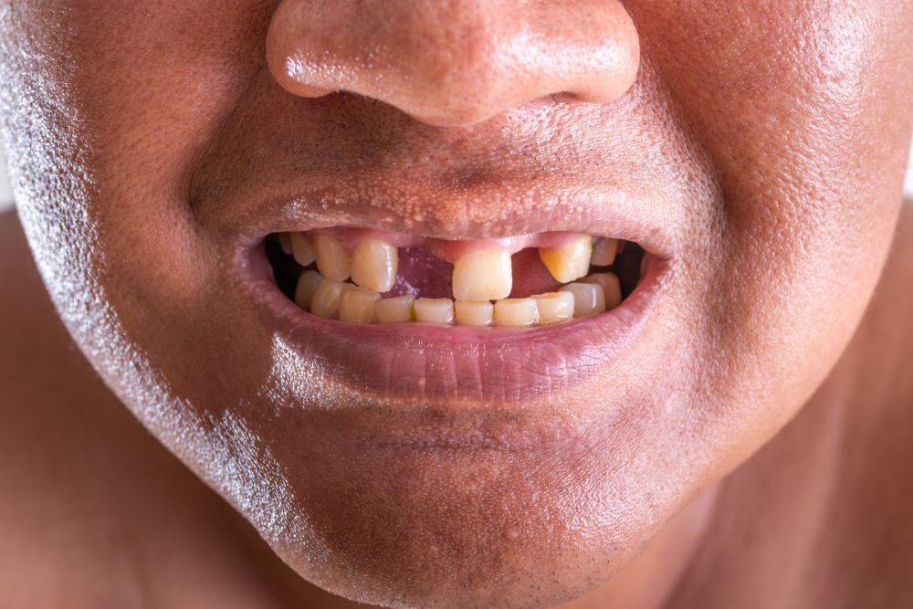 Close-up of a person's mouth with missing and discolored teeth, showing an unhappy expression.